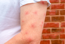 How to Relieve Itching and Inflammation from Bed Bug Bites