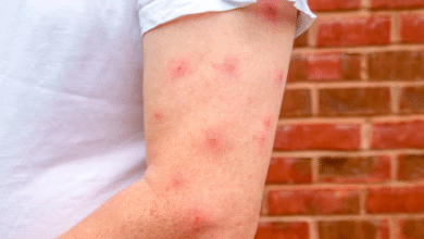 How to Relieve Itching and Inflammation from Bed Bug Bites