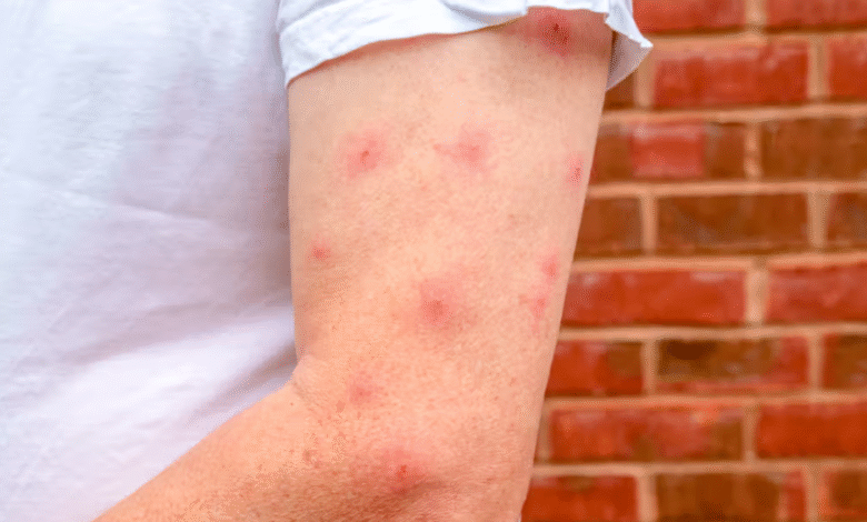 How to Relieve Itching and Inflammation from Bed Bug Bites