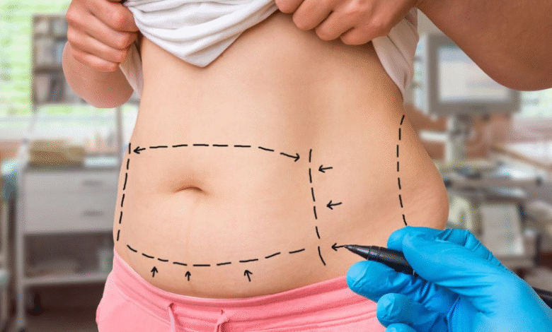 Is a Tummy Tuck in Dubai the Key to Reclaiming Your Abdominal Confidence?