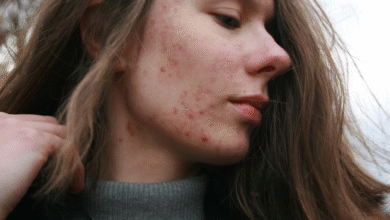 Effective Approaches to Managing Chronic Skin Conditions